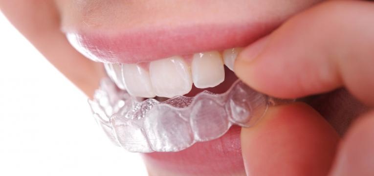 invisalign