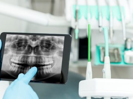 Implante dentário: o que é, tipos e preços