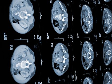 Cancro do fígado: tratamentos e factores de risco