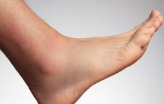 Pés inchados: causas e tratamento