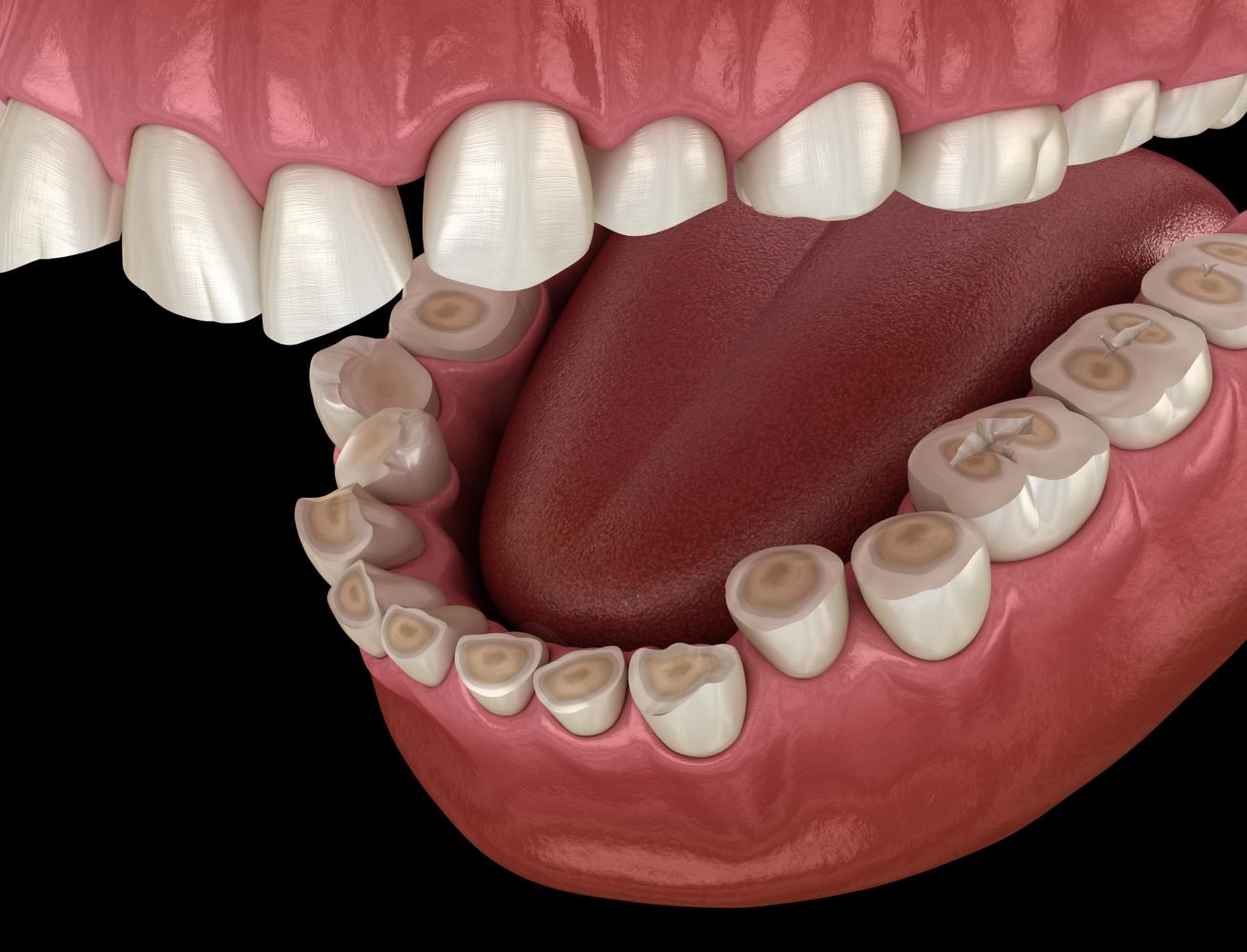 Consequência do bruxismo nos dentes