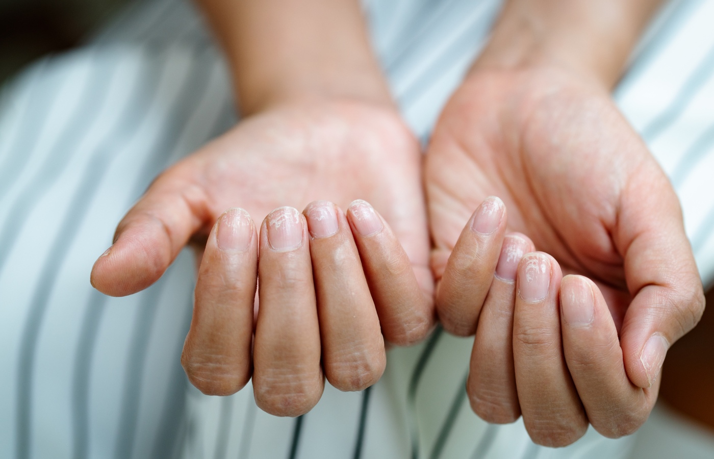 unhas das mãos com manchas brancas ou leuconiquia