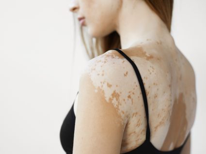 mulher com vitiligo nas costas