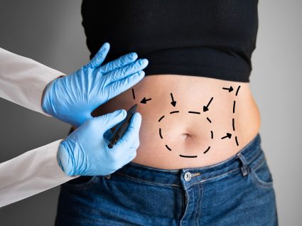 abdominoplastia