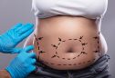 abdominoplastia