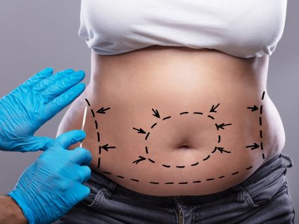 abdominoplastia